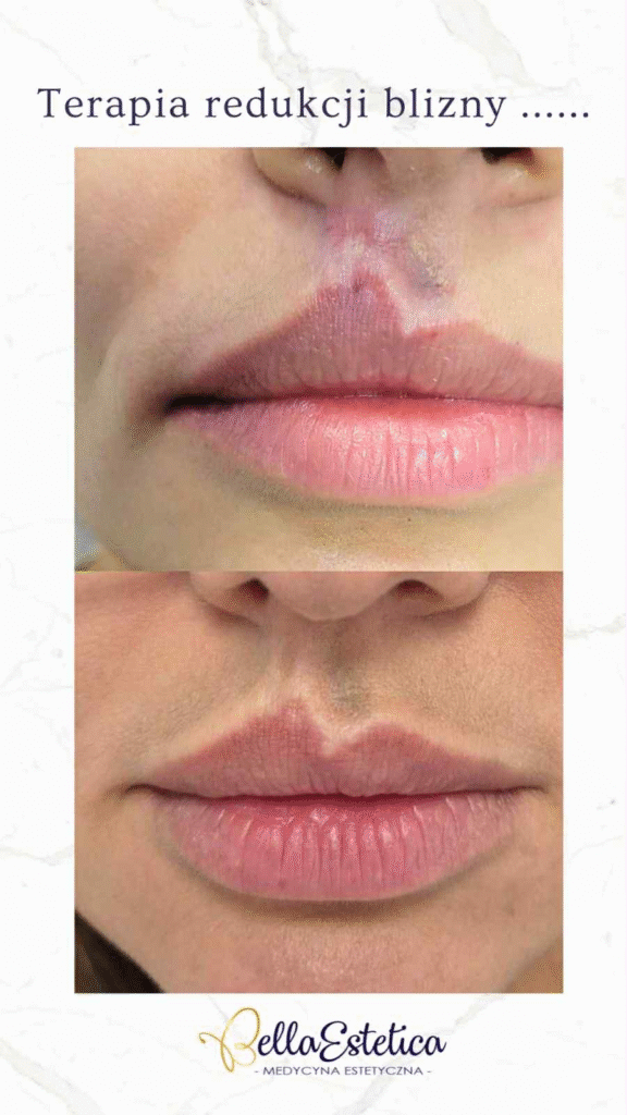 Korekcja ust po urazach – medycyna estetyczno-naprawcza w praktyce 1 image
